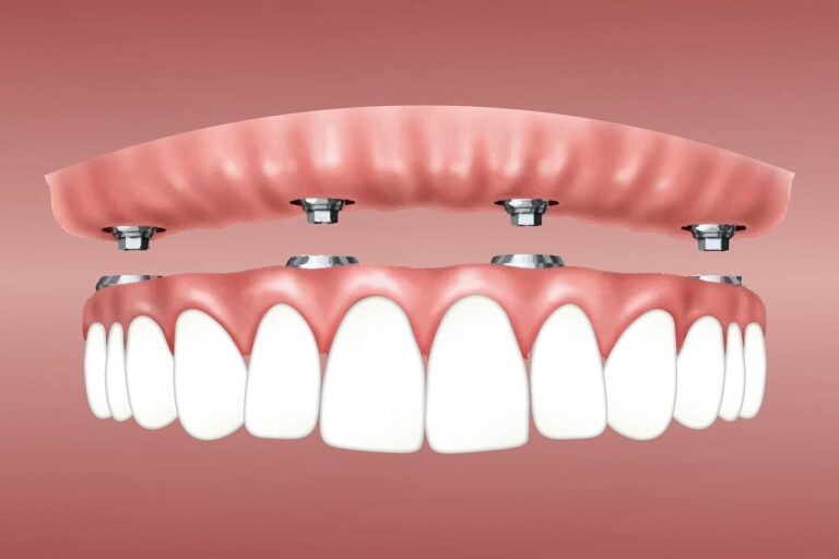 Successful Implants